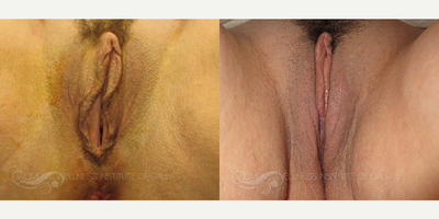 Case: 7675 - before and after photo of 40 year old woman treated with Vaginoplasty by Wesley Anne Brady, MD