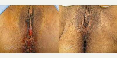 Case: 7678 - before and after photo of 53 year old woman treated with Vaginoplasty by Wesley Anne Brady, MD