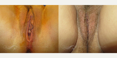 Case 7680 - 45 year old woman treated with Vaginoplasty