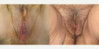 Case 7681 - 45 year old woman treated with Vaginoplasty