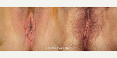 Case 7684 - 38 year old woman treated with Vaginoplasty
