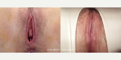 Case 7686 - 35-44 year old woman treated with Vaginoplasty