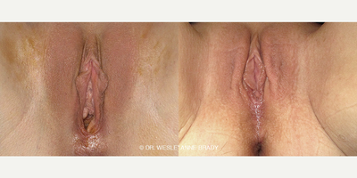 Case 7687 - 47 year old woman treated with Vaginoplasty