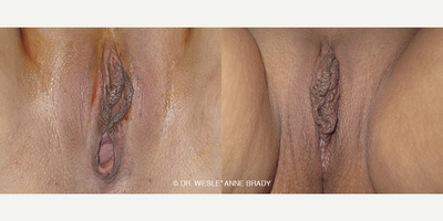 Case 7688 - 34 year old woman treated with Vaginoplasty