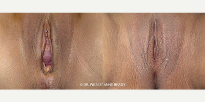 Case 7689 - 36 year old woman treated with Vaginoplasty