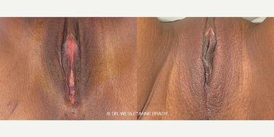 Case 7690 - 40 year old woman treated with Vaginoplasty