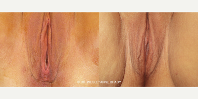 Case 7696 - 25-34 year old woman treated with Vaginoplasty