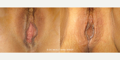 Case 7697 - 44 year old woman treated with Vaginoplasty