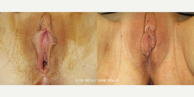 Case 7698 - 36 year old woman treated with Vaginoplasty