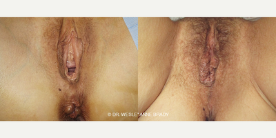 Case 7699 - 45-54 year old woman treated with Vaginoplasty