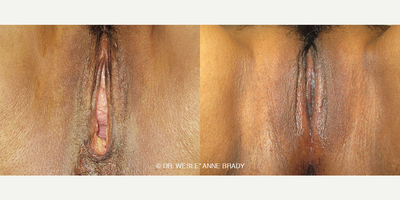 Case 7701 - 49 year old woman treated with Vaginoplasty