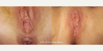 Case 7702 - 53 year old woman treated with Vaginoplasty