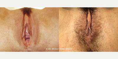 Case 7703 - 53 year old woman treated with Vaginoplasty