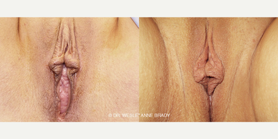 Case 7704 - 50 year old woman treated with Vaginoplasty