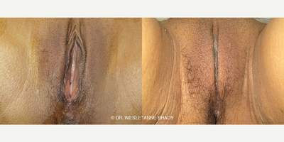 Case 7706 - Woman treated with Vaginoplasty