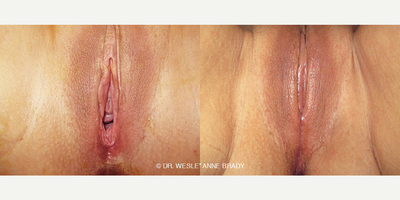 Case 7707 - Woman treated with Vaginoplasty