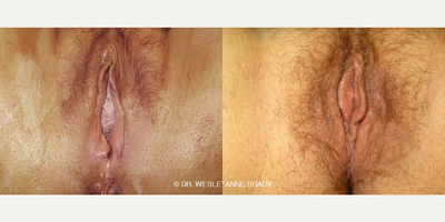 Case 7708 - Woman treated with Vaginoplasty