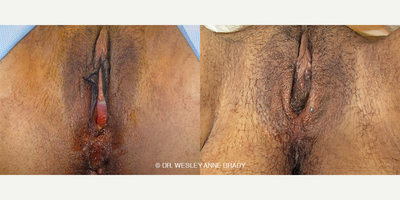Case 7711 - Woman treated with Vaginoplasty