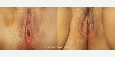 Case 7713 - Woman treated with Vaginoplasty