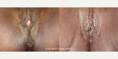 Case 7714 - Woman treated with Vaginoplasty