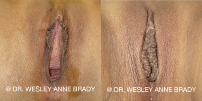 Case 7715 - 35-44 year old woman treated with Vaginoplasty