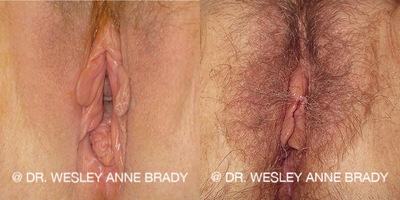 Case 7716 - 25-34 year old woman treated with Vaginoplasty