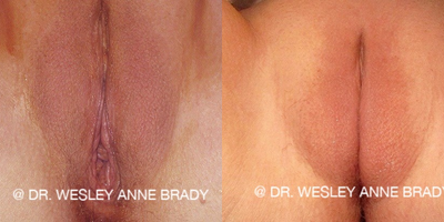 Case 7717 - 35-44 year old woman treated with Vaginoplasty