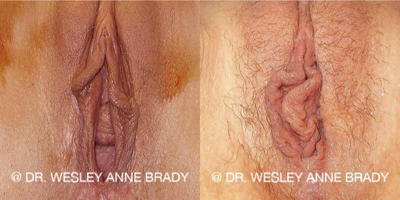 Case 7718 - 35-44 year old woman treated with Vaginoplasty