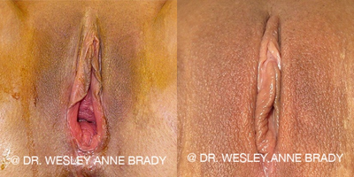 Case 7719 - 35-44 year old woman treated with Vaginoplasty