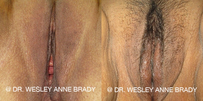 Case 7720 - 35-44 year old woman treated with Vaginoplasty