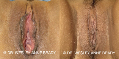 Case 7721 - 35-44 year old man treated with Vaginoplasty