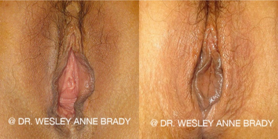 Case 7722 - 35-44 year old woman treated with Vaginoplasty