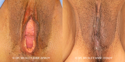 Case 7725 - 35-44 year old woman treated with Vaginoplasty