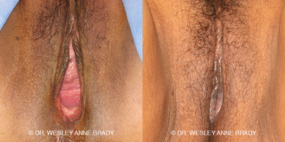 Case 7726 - 45-54 year old woman treated with Vaginoplasty