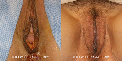 Case 7727 - 35-44 year old woman treated with Vaginoplasty
