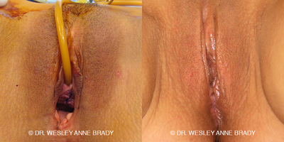 Case 7728 - 45-54 year old woman treated with Vaginoplasty