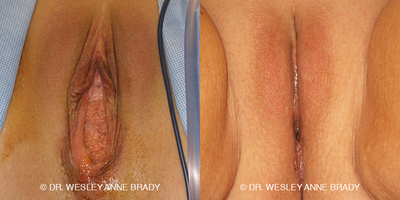 Case 7729 - 35-44 year old woman treated with Vaginoplasty
