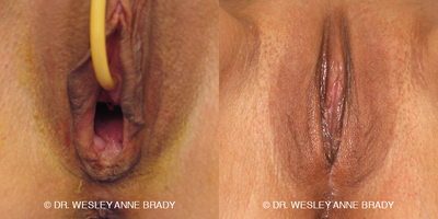 Case 7730 - 45-54 year old woman treated with Vaginoplasty