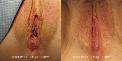 Case 7731 - 45-54 year old woman treated with Vaginoplasty