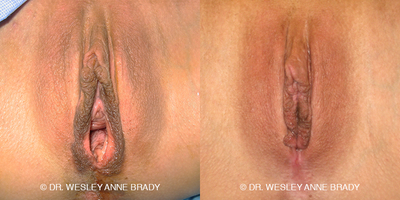 Case 7732 - 35-44 year old woman treated with Vaginoplasty