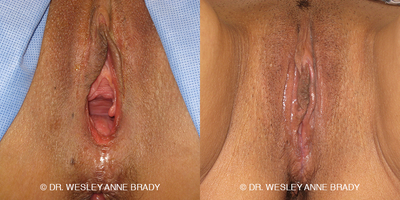 Case 7733 - 45-54 year old woman treated with Vaginoplasty