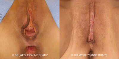 Case 7734 - 35-44 year old woman treated with Vaginoplasty