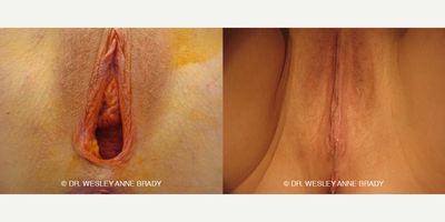 Case 7735 - 45-54 year old woman treated with Vaginoplasty