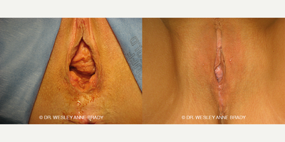 Case 7736 - 45-54 year old woman treated with Vaginoplasty