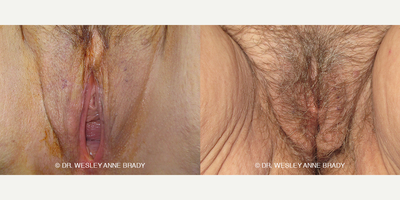 Case 7737 - 45-54 year old woman treated with Vaginoplasty