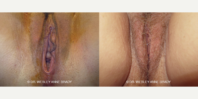 Case 7738 - 45-54 year old woman treated with Vaginoplasty