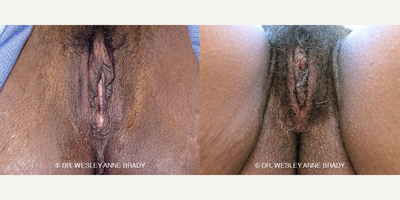 Case 7739 - 35-44 year old woman treated with Vaginoplasty