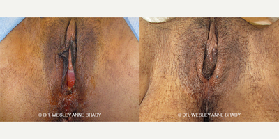 Case 7741 - 35-44 year old woman treated with Vaginoplasty