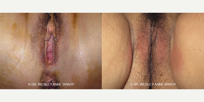 Case 7742 - 45-54 year old woman treated with Vaginoplasty