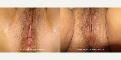 Case 7743 - 45-54 year old woman treated with Vaginoplasty